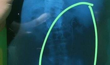 RSUD Batang Jelaskan soal Heboh Selang Tertinggal di Tubuh Pasien Usai Operasi 6 Selang Tertinggal di Tubuh Pasien