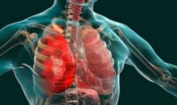 Dokter Bagikan Cara Kurangi Peradangan Secara Alami